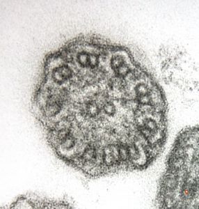 F,5y. | immotile cilia syndrome - nasal mucosa F,5y. | immotile cilia syndrome - nasal mucosa